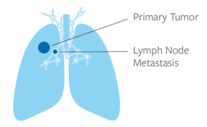 What is Lung Cancer? | Lung Cancer Research Foundation