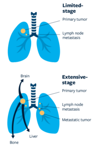 new research on lung cancer