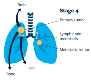 Lung cancer overview - Lung Cancer Research Foundation